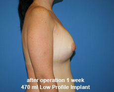 plastic-surgery-breast-augmentation